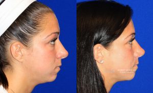  Female face, before and after rhinoplasty treatment, r-side view, patient 39