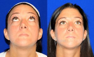  Female face, before and after rhinoplasty treatment, front view (thrown back) - patient 39