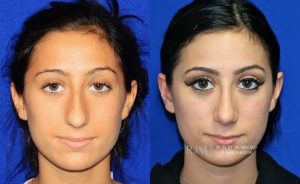  Female face, before and after rhinoplasty treatment, front view, patient 40