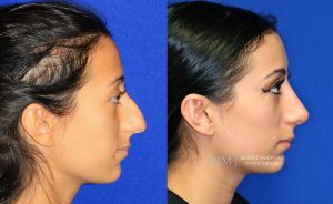  Female face, before and after rhinoplasty treatment, r-side view, patient 40