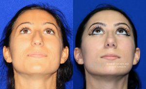  Female face, before and after rhinoplasty treatment, front view (thrown back) - patient 40