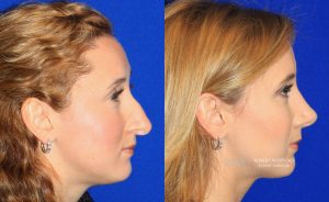  Female face, before and after rhinoplasty treatment, r-side view, patient 7