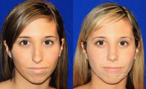  Female face, before and after rhinoplasty treatment, front view, patient 41