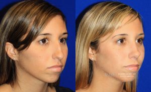  Female face, before and after rhinoplasty treatment, oblique view, patient 41