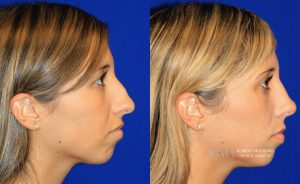  Female face, before and after rhinoplasty treatment, r-side view, patient 41