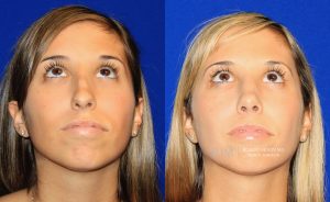 Female face, before and after rhinoplasty treatment, front view (thrown back) - patient 41