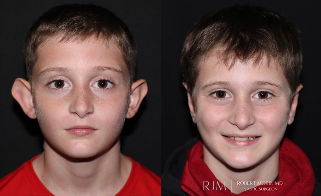  Boy face, before and after Ear Reconstruction treatment in New Jersey, front view, patient 2