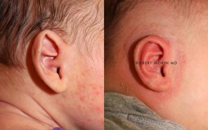  Infant ear, before and after EarWell Infant Ear Molding treatment, r-side view, patient 2