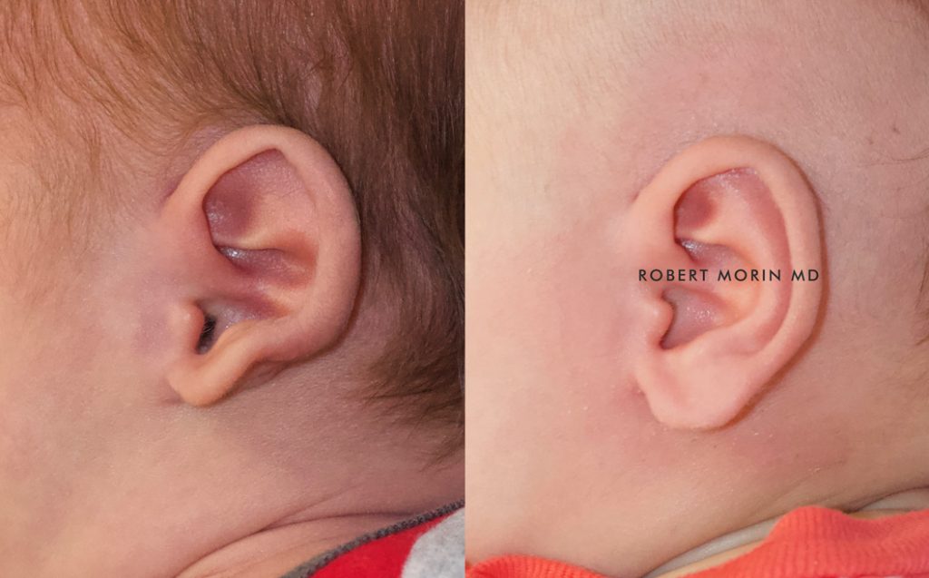  Infant ear, before and after EarWell Infant Ear Molding treatment, l-side view, patient 24