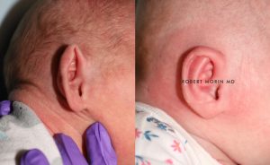  Infant ear, before and after EarWell Infant Ear Molding treatment, r-side view, patient 6