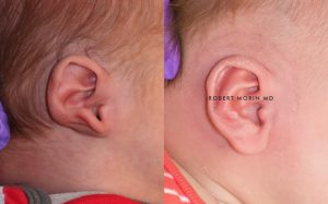  Infant ear, before and after EarWell Infant Ear Molding treatment, r-side view, patient 12