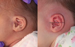  Infant ear, before and after EarWell Infant Ear Molding treatment, l-side view, patient 26