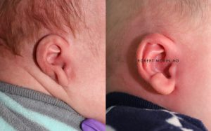  Infant ear, before and after EarWell Infant Ear Molding treatment, r-side view, patient 25