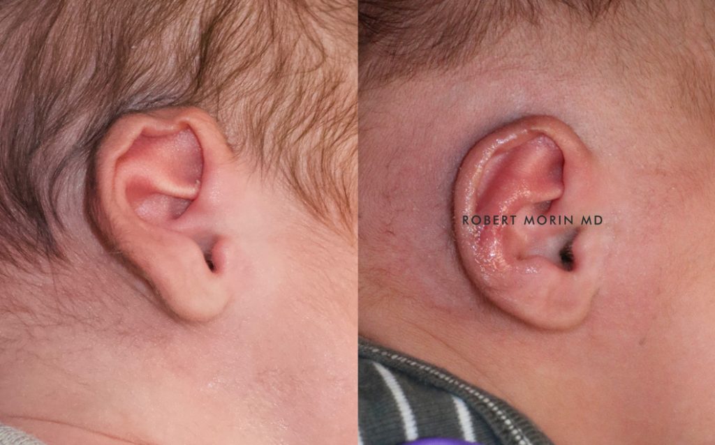  Infant ear, before and after EarWell Infant Ear Molding treatment, r-side view, patient 14
