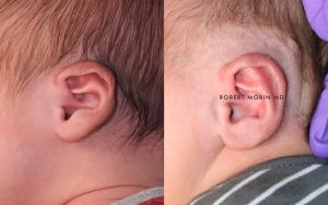  Infant ear, before and after EarWell Infant Ear Molding treatment, l-side view, patient 16