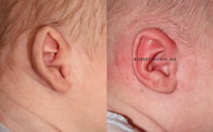  Infant ear, before and after EarWell Infant Ear Molding treatment, r-side view, patient 8