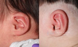  Infant ear, before and after EarWell Infant Ear Molding treatment, l-side view, patient 7