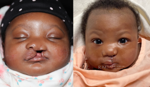  Child face, before and after Cleft Lip Repair treatment, front view - patient 3