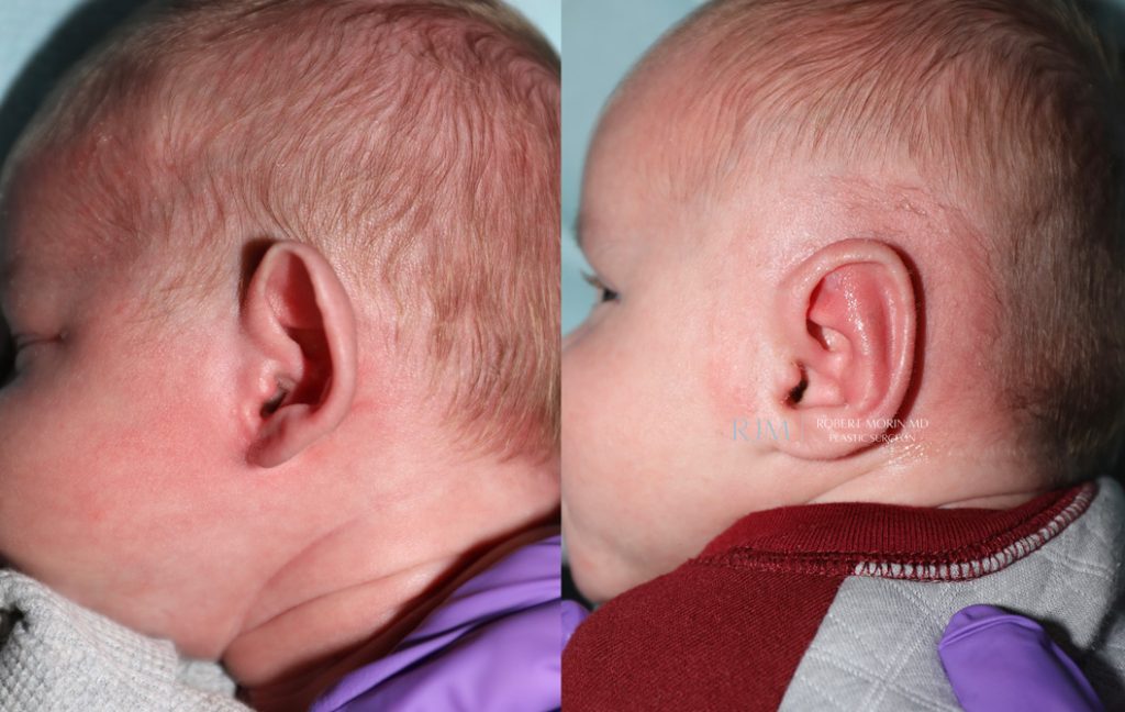  Infant ear, before and after EarWell Infant Ear Molding treatment, l-side view, patient 1