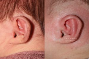  Infant ear, before and after EarWell Infant Ear Molding treatment, l-side view, patient 22