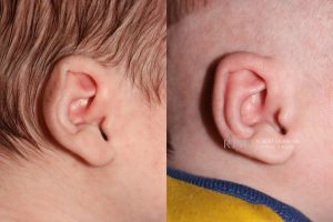  Infant ear, before and after EarWell Infant Ear Molding treatment, r-side view, patient 23