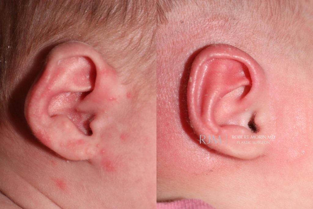  Infant ear, before and after EarWell Infant Ear Molding treatment, r-side view, patient 17