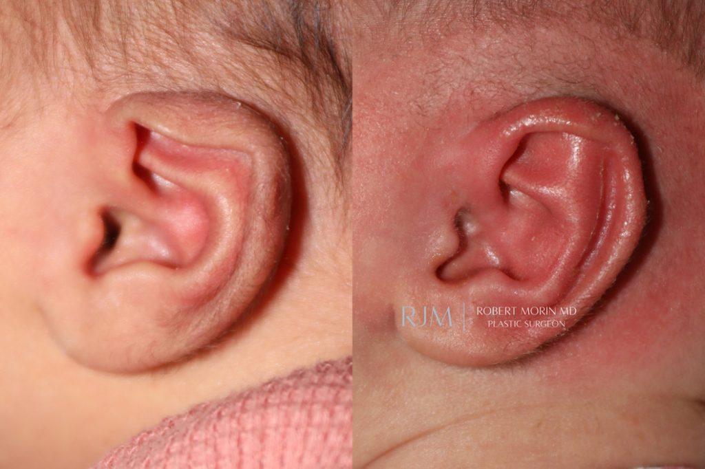  Infant ear, before and after EarWell Infant Ear Molding treatment, l-side view, patient 19