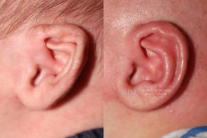  Infant ear, before and after EarWell Infant Ear Molding treatment, l-side view, patient 20
