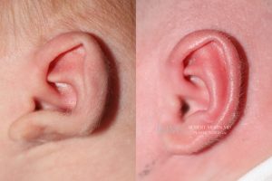  Infant ear, before and after EarWell Infant Ear Molding treatment, l-side view, patient 13
