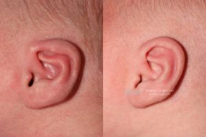  Infant ear, before and after EarWell Infant Ear Molding treatment, l-side view, patient 18