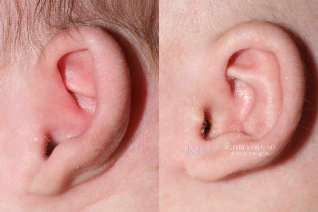  Infant ear, before and after EarWell Infant Ear Molding treatment, l-side view, patient 15