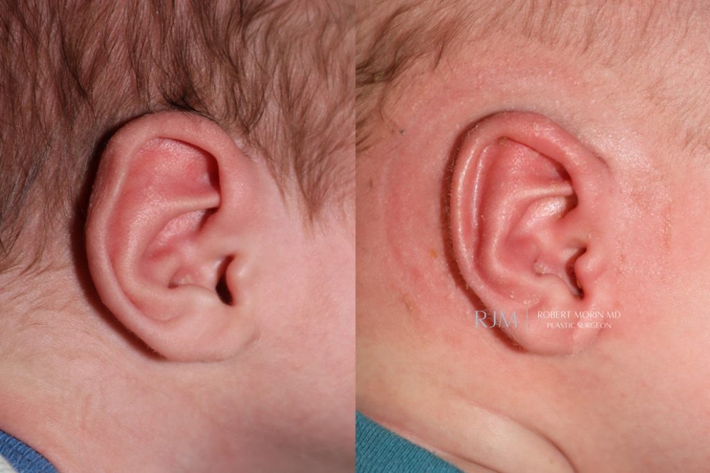  Infant ear, before and after EarWell Infant Ear Molding treatment, r-side view, patient 10