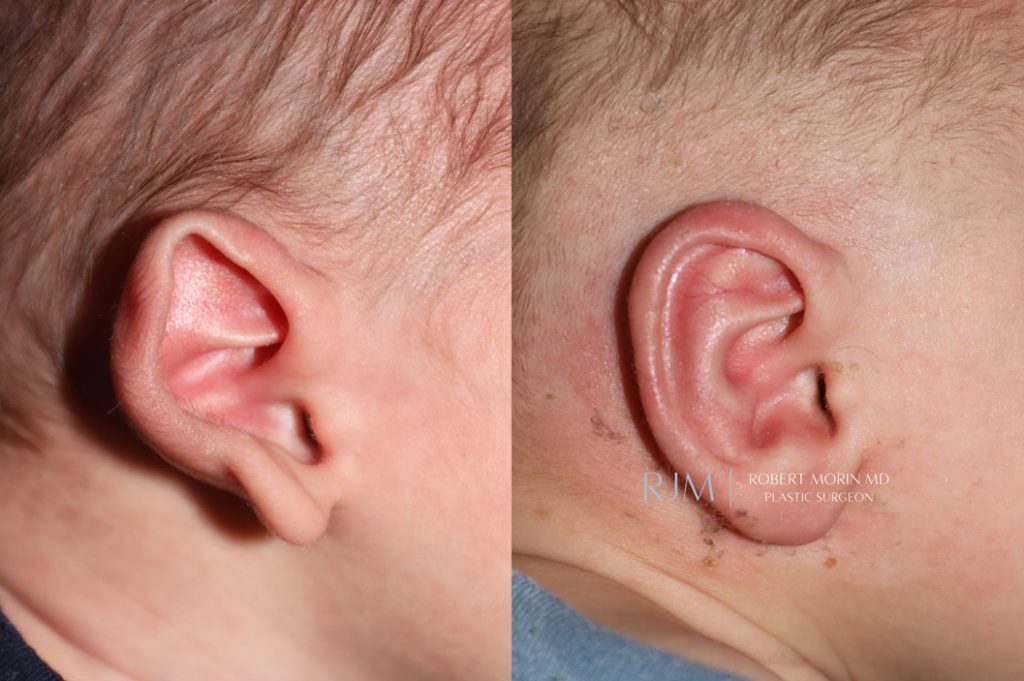  Infant ear, before and after EarWell Infant Ear Molding treatment, r-side view, patient 9