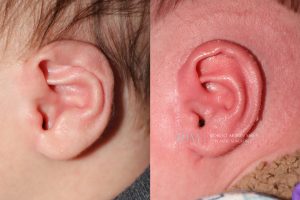  Infant ear, before and after EarWell Infant Ear Molding treatment, l-side view, patient 11