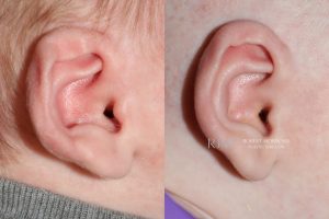  Infant ear, before and after EarWell Infant Ear Molding treatment, r-side view, patient 21