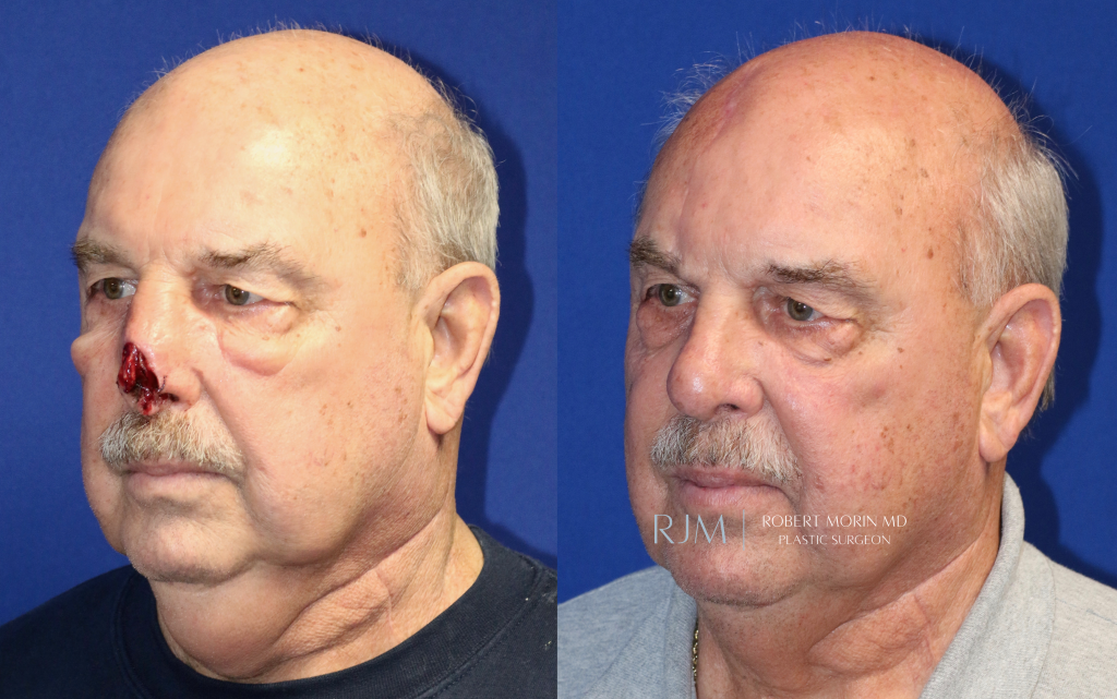  Male face, before and after Nasal Reconstruction treatment, oblique view, patient 2