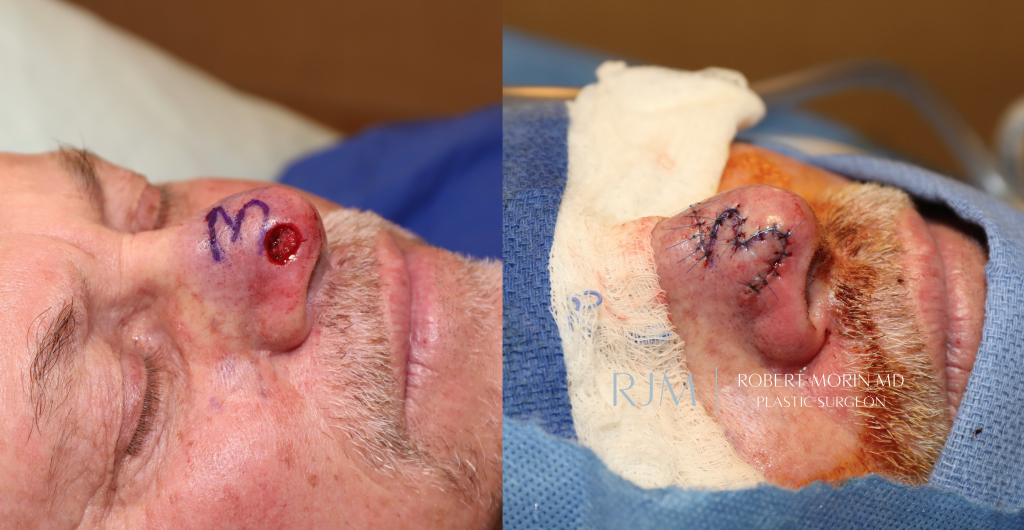  Male face, before and after Nasal Reconstruction treatment, side view, patient 6