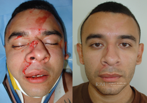  Male face, before and after Nasal Reconstruction treatment, front view, patient 5