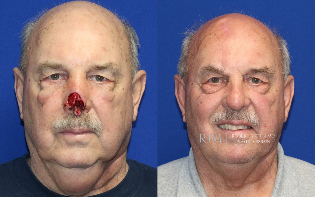  Male face, before and after Nasal Reconstruction treatment, front view, patient 2