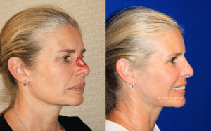  Female face, before and after Nasal Reconstruction treatment, oblique view, patient 4