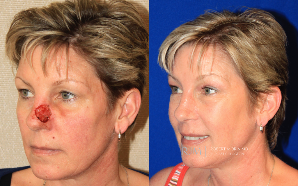  Female face, before and after Nasal Reconstruction treatment, oblique view, patient 3