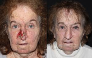  Female face, before and after Nasal Reconstruction treatment, front view, patient 1