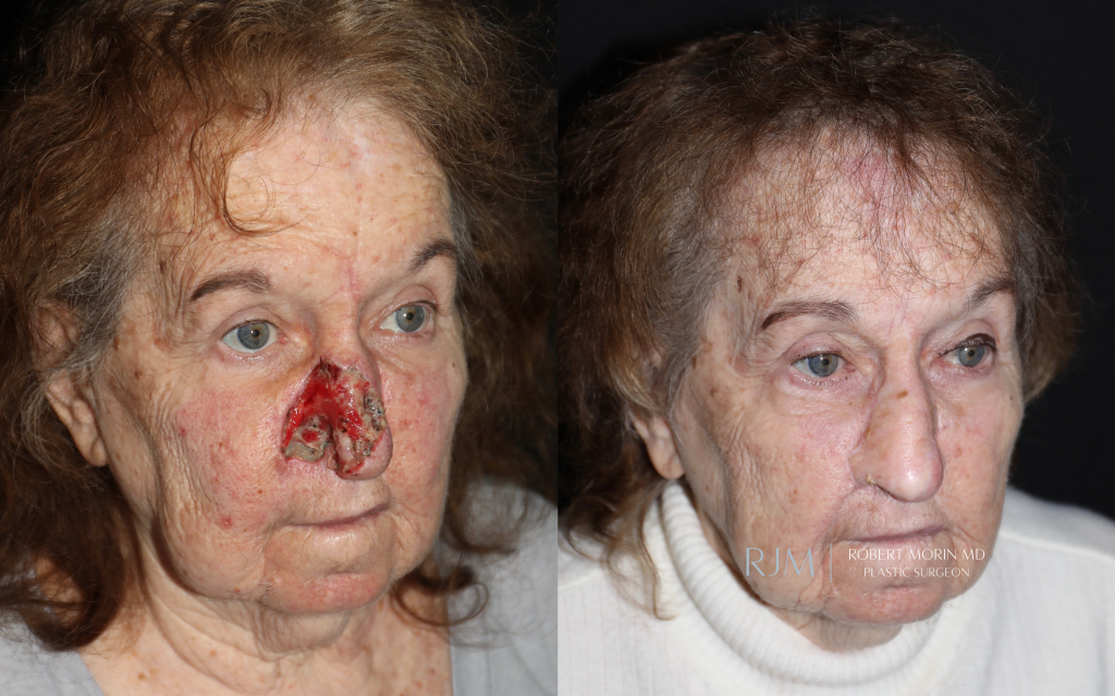  Female face, before and after Nasal Reconstruction treatment, oblique view, patient 1