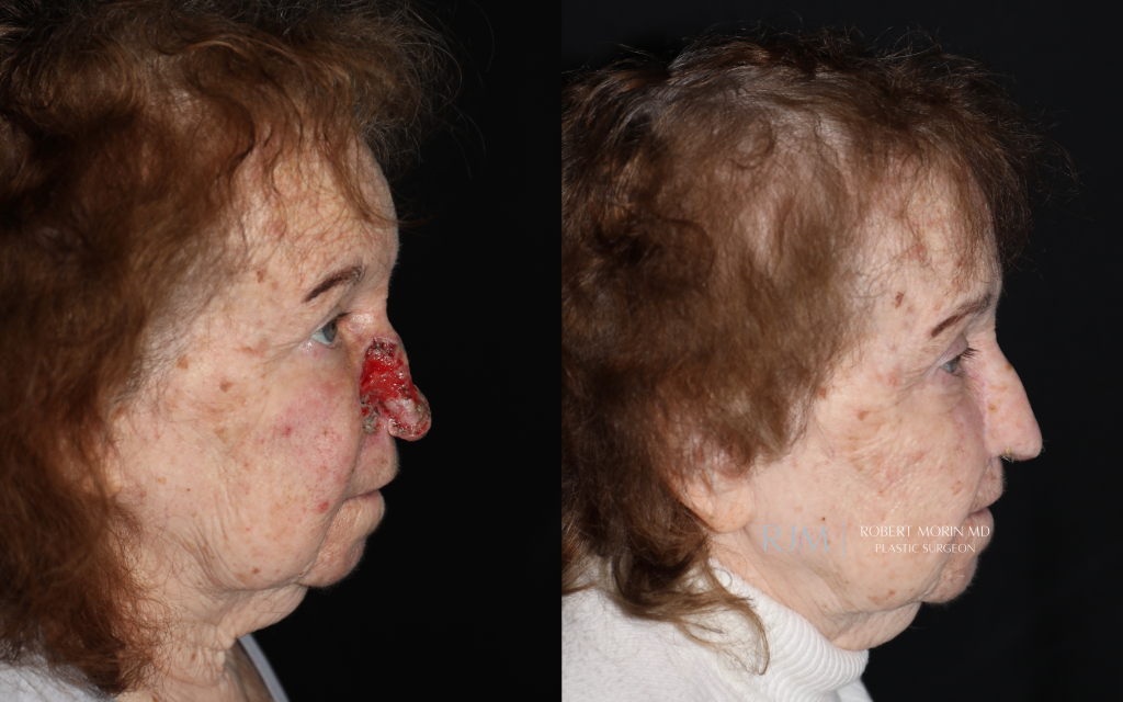  Female face, before and after Nasal Reconstruction treatment, side view, patient 1