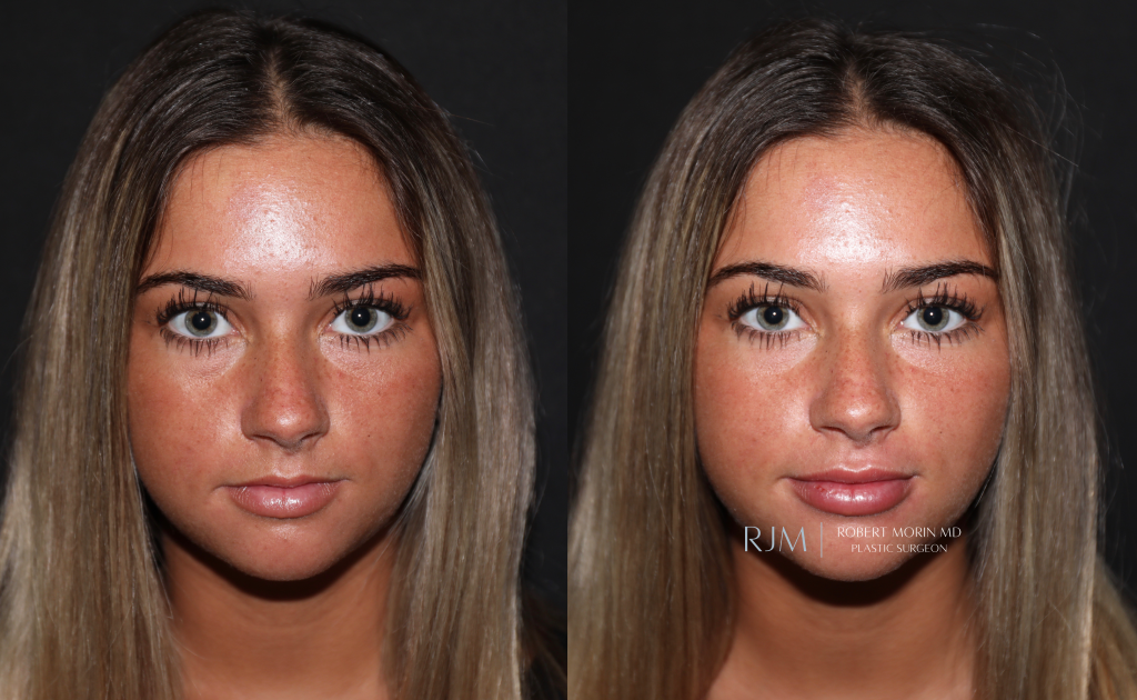  Female face, before and after Lip Augmentation treatment in New Jersey, front view, patient 1