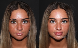  Female face, before and after Lip Augmentation treatment, front view, patient 1