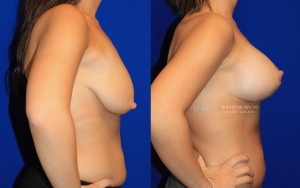 Woman's body, before and after Breast Augmentation treatment, r-side view, patient 37
