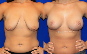  Woman's body, before and after Breast Augmentation treatment, front view, patient 37