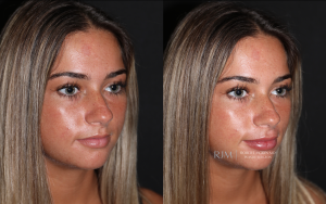  Female face, before and after Lip Augmentation treatment, oblique view, patient 1
