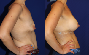  Female body, before and after Breast Lift treatment, r-side view, patient 13